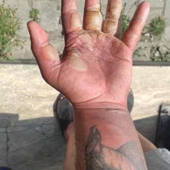 Yertaş Havai Fişek Yüzünden 2. Derece Yanık