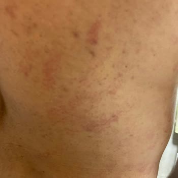 Bionep Güzellik Merkezi Giden Herkesi Yaktılar İsi Bilmiyorlar Hijyen 0 Ispartakule Şube