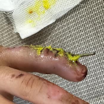 Koru Hastanesi Estetik Uzmanının Yanlış Ameliyat Yapması