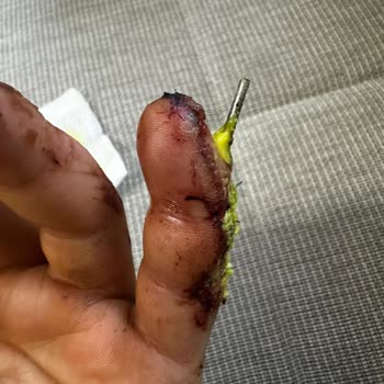 Koru Hastanesi Estetik Uzmanının Yanlış Ameliyat Yapması