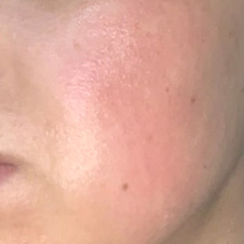 The Purest Solutions Purest Solutions Alerji Yapıyor