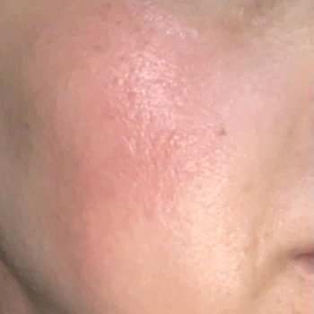 The Purest Solutions Purest Solutions Alerji Yapıyor