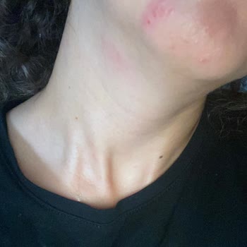 Shevec Glyc Alright 7%Glycolic Acid+Ginseng+Niacinamide Sivilce Yaptı