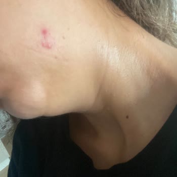 Shevec Glyc Alright 7%Glycolic Acid+Ginseng+Niacinamide Sivilce Yaptı