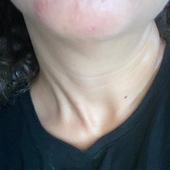 Shevec Glyc Alright 7%Glycolic Acid+Ginseng+Niacinamide Sivilce Yaptı