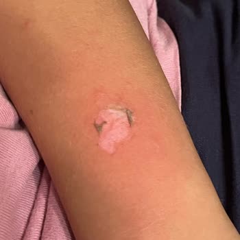 Turkcell Xee Kids Marka Telefon Saat Çocuğun Kolunu Yaktı!