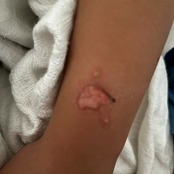 Turkcell Xee Kids Marka Telefon Saat Çocuğun Kolunu Yaktı!