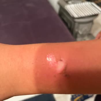 Turkcell Xee Kids Marka Telefon Saat Çocuğun Kolunu Yaktı!