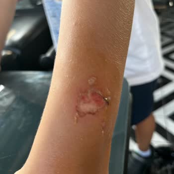 Turkcell Xee Kids Marka Telefon Saat Çocuğun Kolunu Yaktı!