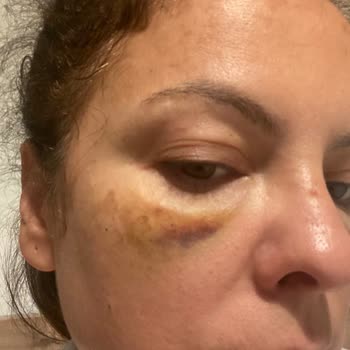 Clinic Gd Gözaltı Işık Dolgusu Yanlış Uygulama!