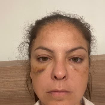 Clinic Gd Gözaltı Işık Dolgusu Yanlış Uygulama!