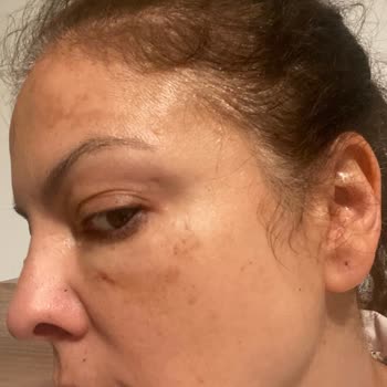 Clinic Gd Gözaltı Işık Dolgusu Yanlış Uygulama!