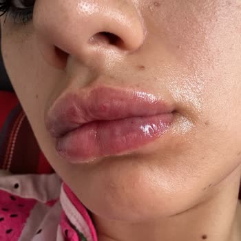 Pınar Onur Official Dudak Vitamin İşlemi