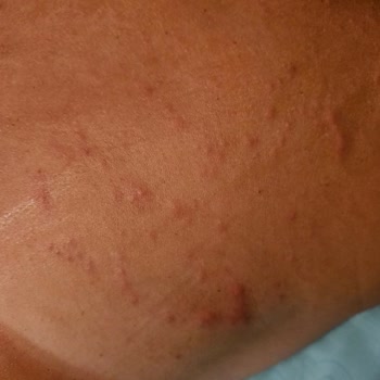 La Roche Posay Güneş Kremi Alerji Yaptı