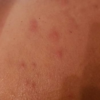 La Roche Posay Güneş Kremi Alerji Yaptı