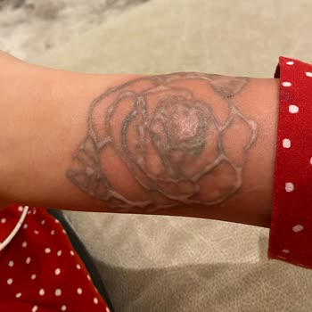 Akumer Polikliniği Akumer Poliklinik Dövme Silimi