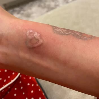 Akumer Polikliniği Akumer Poliklinik Dövme Silimi