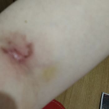 Beyhekim Eğitim ve Araştırma Hastanesi Hastane Acilinde Serum Takılırken Koluma Zarar Verildi