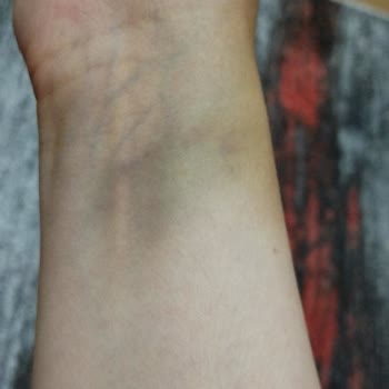 Beyhekim Eğitim ve Araştırma Hastanesi Hastane Acilinde Serum Takılırken Koluma Zarar Verildi