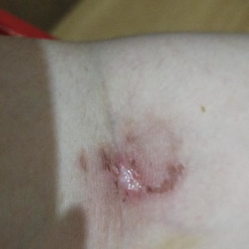 Beyhekim Eğitim ve Araştırma Hastanesi Hastane Acilinde Serum Takılırken Koluma Zarar Verildi