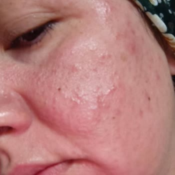 Avene Çok Kötü Alerji Yapıyor