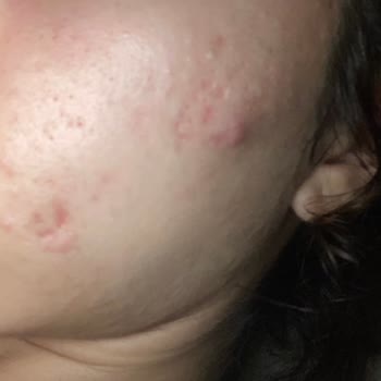 Yves Rocher Nemlendirici Krem Sivilcelenme Yaptı