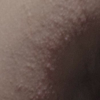 Eda Taşpınar Bronzlaştırıcı Kaşıntılı Kabarcıklar Yaptı