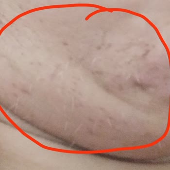 La Liva Beauty Studio Academy Lazer Epilasyon İğneli Skar Oluşumu