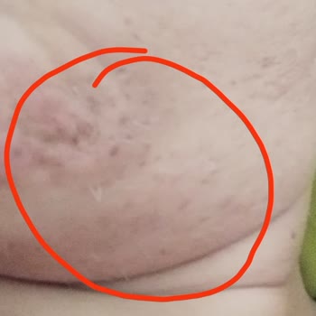 La Liva Beauty Studio Academy Lazer Epilasyon İğneli Skar Oluşumu