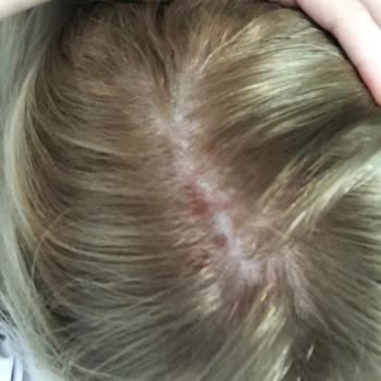 Palette Saç Boyası Saç Derimde Yara Yaptı