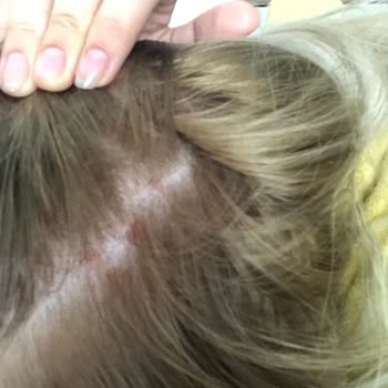 Palette Saç Boyası Saç Derimde Yara Yaptı