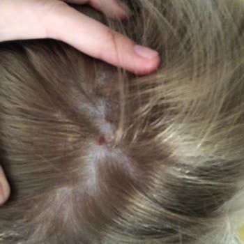 Palette Saç Boyası Saç Derimde Yara Yaptı