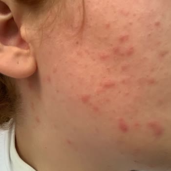 La Roche Posay C Vitamini Alerji