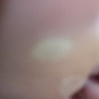 Skechers Sol Ayağımın Tabanının Su Toplanması!