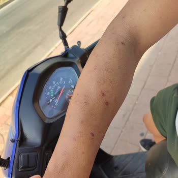 Enza Güzellik Merkezleri Lazer Sonrası Kolda Oluşan Yanıklar