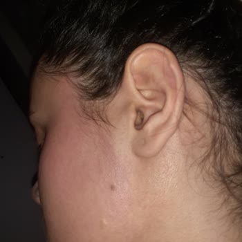 Dermokil Maskenin Yaptığı Alerji