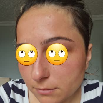 Nivea Canlandırıcı Jel Yüzümü Yaktı