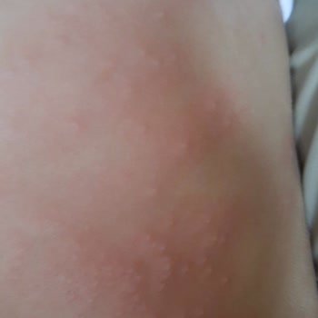 BİM'de Satılan Bebeto Marka Sakız Alerjik Duruma Neden Oldu