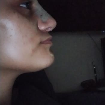 Procsin Yüz Temizleme Jeli Sivilce Oluşumu Yaptı