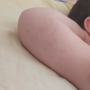 Siveno Güneş Kremi Alerji Yaptı.