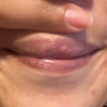 Burcu Beauty Center Dudak Vitamini Uygulaması Noktalar Oluşturdu