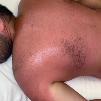 Sebamed Güneş Kremi Yanık Oluşturdu