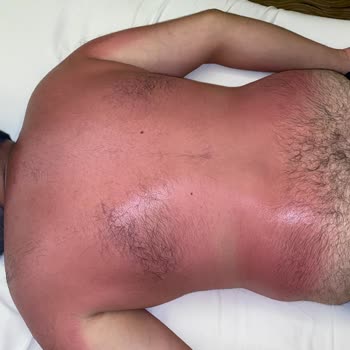 Sebamed Güneş Kremi Yanık Oluşturdu