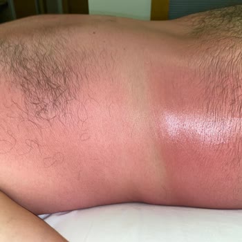 Sebamed Güneş Kremi Yanık Oluşturdu