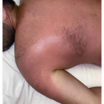 Sebamed SPF 50 Sunscreen Protection Is So Low It Caused Sun Burns