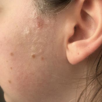 Ümran Tıp Merkezi Yüzde Yanık Oluşması