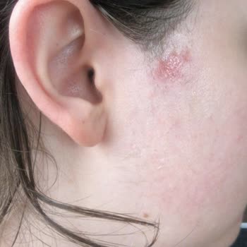 Ümran Tıp Merkezi Yüzde Yanık Oluşması