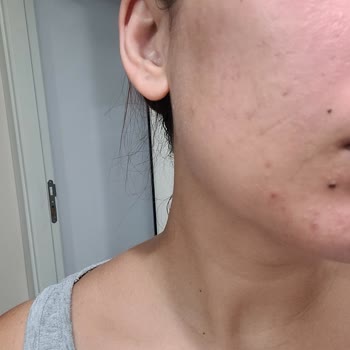 Yves Rocher Pure Menthe Yüz Temizleme Jeli Kızarıklık Ve Tahriş Sorunu