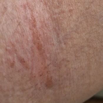 Agiss Tüy Dökücü Sprey Kolumu Yaktı