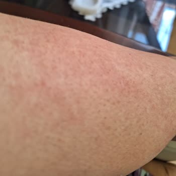 Agiss Tüy Dökücü Sprey Kolumu Yaktı